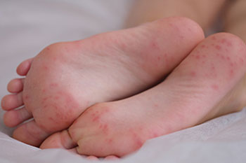 infectious diseases of the foot